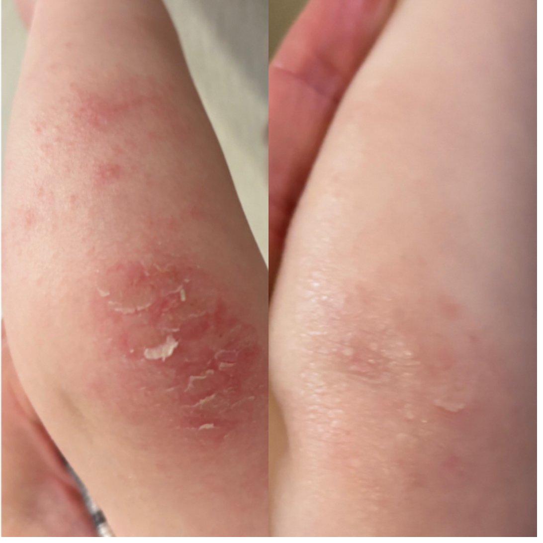 Before and after eczema healing result
