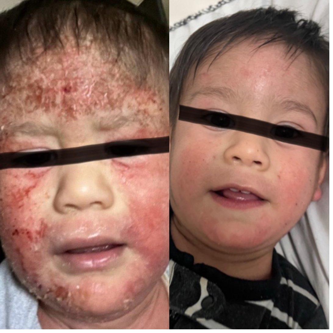 Before and after eczema healing result